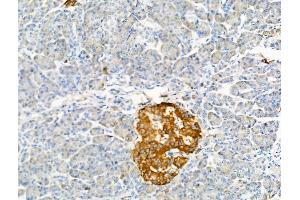 ABIN7093126 and ABIN7098645 at 1/100 staining Human pancreatic cancer and adjacent nomal tissues by IHC-P. (Factor VII Antikörper)