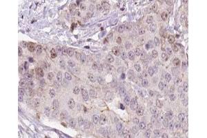 ABIN6266557 at 1/100 staining human liver carcinoma tissue sections by IHC-P. (HCG beta Antikörper)