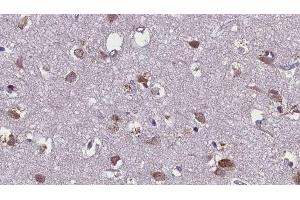 ABIN6276107 at 1/100 staining Human brain cancer tissue by IHC-P. (Mu Opioid Receptor 1 Antikörper  (C-Term))