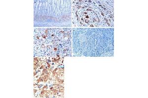 (TOP)Immunohistochemical analysis of EphB1 in gastric cancer tissues. (EPH Receptor B1 Antikörper  (C-Term))
