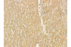 ABIN6261936 and ABIN6273247 at 1/100 staining human hepatocellular carcinoma by IHC-P. (ARHGEF25/GEFT Antikörper  (Internal Region))