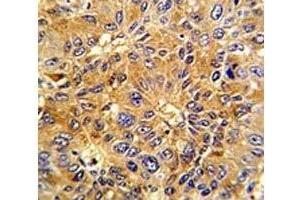 IHC analysis of FFPE human hepatocarcinoma with Cyclin A2 antibody (Cyclin A Antikörper  (AA 51-84))