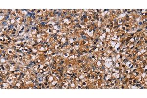 Immunohistochemistry of paraffin-embedded Human prostate cancer using NPM3 Polyclonal Antibody at dilution of 1:60 (NPM3 Antikörper)