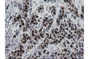 Immunohistochemical staining of paraffin-embedded Carcinoma of Human lung tissue using anti-HSPBP1 mouse monoclonal antibody. (HSPBP1 Antikörper)