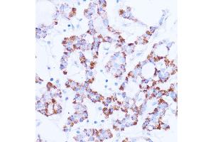 Immunohistochemistry of paraffin-embedded human thyroid cancer using SIRT3 antibody  at dilution of 1:100 (40x lens). (SIRT3 Antikörper  (C-Term))
