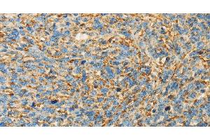 Immunohistochemistry of paraffin-embedded Human ovarian cancer tissue using APOA4 Polyclonal Antibody at dilution 1:30 (APOA4 Antikörper)