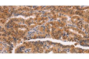 Immunohistochemistry of paraffin-embedded Human thyroid cancer tissue using NCAPG2 Polyclonal Antibody at dilution 1:50 (NCAPG2 Antikörper)