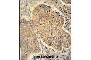 PSMD7 Antibody (C-term) (ABIN650763 and ABIN2839523) immunohistochemistry analysis in formalin fixed and paraffin embedded human lung carcinoma followed by peroxidase conjugation of the secondary antibody and DAB staining.