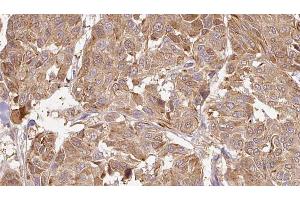 ABIN6268902 at 1/100 staining Human Melanoma tissue by IHC-P. (MMP13 Antikörper  (N-Term))