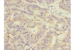 Immunohistochemistry of paraffin-embedded human colon cancer using ABIN7154098 at dilution of 1:100