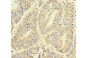 Immunohistochemistry of paraffin-embedded human colon cancer using ABIN7145012 at dilution of 1:100 (YME1L1 Antikörper  (AA 1-240))