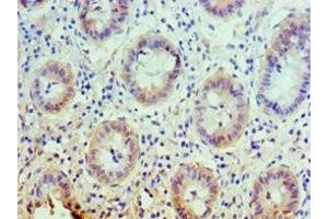 Immunohistochemistry of paraffin-embedded human colon cancer using ABIN7146355 at dilution of 1:100 (slc25a13 Antikörper  (AA 1-300))