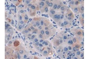 DAB staining on IHC-P; Samples: Human Liver cancer Tissue (CILP Antikörper  (AA 603-846))