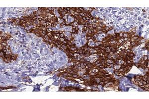 ABIN6272285 at 1/100 staining Human Head and neck cancer tissue by IHC-P. (DCL1 Antikörper  (Internal Region))