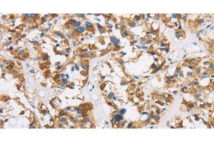 Immunohistochemistry of paraffin-embedded Human thyroid cancer using COX6B1 Polyclonal Antibody at dilution of 1:50 (COX6B1 Antikörper)