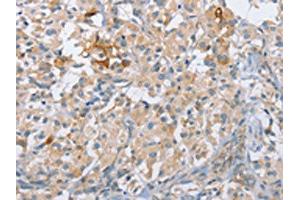 The image on the left is immunohistochemistry of paraffin-embedded Human thyroid cancer tissue using ABIN7190211(CENPE Antibody) at dilution 1/50, on the right is treated with synthetic peptide. (CENPE Antikörper)