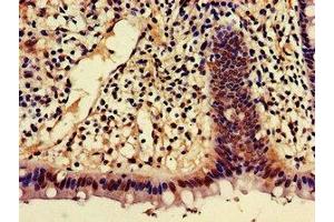 Immunohistochemistry of paraffin-embedded human colon cancer using ABIN7143368 at dilution of 1:100 (AJAP1 Antikörper  (AA 308-394))