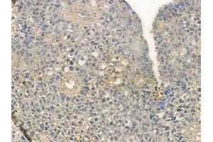ABIN6257290 and ABIN6273658 at 1/100 staining human glioblastoma by IHC-P. (IL-25 Antikörper  (Internal Region))