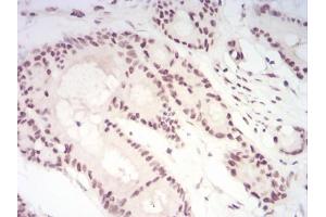 Immunohistochemical analysis of paraffin-embedded colon cancer tissues using CBX1 mouse mAb with DAB staining. (CBX1 Antikörper  (AA 1-185))
