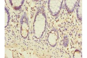 Immunohistochemistry of paraffin-embedded human colon cancer using ABIN7151978 at dilution of 1:100 (TMEM93 Antikörper  (AA 2-47))