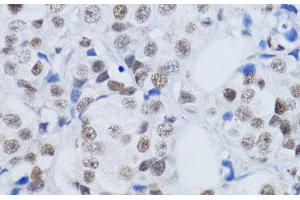 Immunohistochemistry of paraffin-embedded Human mammary cancer using DiMethyl-Histone H3-K79 Polyclonal Antibody at dilution of 1:200 (40x lens).