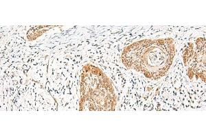 Immunohistochemistry of paraffin-embedded Human esophagus cancer tissue using HNF1A Polyclonal Antibody at dilution of 1:25(x200) (HNF1A Antikörper)