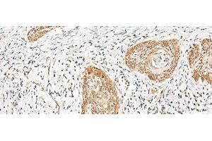 Immunohistochemistry of paraffin-embedded Human esophagus cancer tissue using HNF1A Polyclonal Antibody at dilution of 1:25(x200) (HNF1A Antikörper)