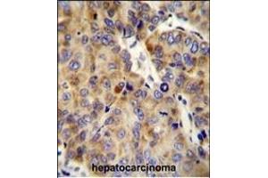 COL18A1 Antibody (Center) (ABIN654663 and ABIN2844359) immunohistochemistry analysis in formalin fixed and paraffin embedded human hepatocarcinoma followed by peroxidase conjugation of the secondary antibody and DAB staining.