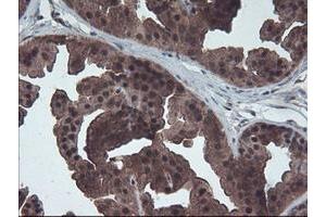 Immunohistochemical staining of paraffin-embedded Human breast tissue using anti-HDHD1 mouse monoclonal antibody. (HDHD1 Antikörper)