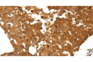 Immunohistochemistry of paraffin-embedded Human breast cancer tissue using SSTR1 Polyclonal Antibody at dilution 1:50 (SSTR1 Antikörper)