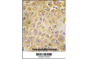 Formalin-fixed and paraffin-embedded human hepatocarcinoma tissue reacted with GRK7 Antibody , which was peroxidase-conjugated to the secondary antibody, followed by DAB staining. (GRK7 Antikörper  (C-Term))