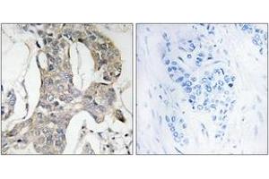 Immunohistochemistry analysis of paraffin-embedded human breast carcinoma, using MKP-1/2 (Phospho-Ser296/318) Antibody. (MKP-1/2 Antikörper  (pSer296))
