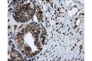 Immunohistochemical staining of paraffin-embedded Adenocarcinoma of breast tissue using anti-MCL1 mouse monoclonal antibody. (MCL-1 Antikörper)
