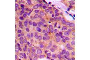 Immunohistochemical analysis of Cytokeratin 17 staining in human breast cancer formalin fixed paraffin embedded tissue section. (KRT17 Antikörper  (C-Term))