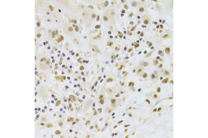 Immunohistochemistry of paraffin-embedded human liver cancer using PPP1R8 Antibody (ABIN5974046) at dilution of 1/100 (40x lens). (PPP1R8 Antikörper)