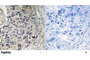 Immunohistochemistry analysis of paraffin-embedded human prostate carcinoma tissue using SLC25A12 polyclonal antibody . (SLC25A12 Antikörper)