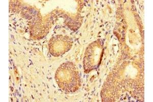 Immunohistochemistry of paraffin-embedded human prostate cancer using ABIN7174763 at dilution of 1:100 (C19ORF44 Antikörper  (AA 101-400))