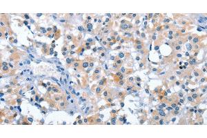 Immunohistochemistry of paraffin-embedded Human thyroid cancer tissue using ASB2 Polyclonal Antibody at dilution 1:50 (ASB2 Antikörper)