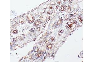 IHC-P: PCSK9 antibody testing of human intestinal cancer tissue (PCSK9 Antikörper  (AA 671-687))