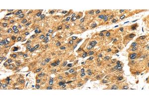 Immunohistochemistry of paraffin-embedded Human liver cancer tissue using SLC25A26 Polyclonal Antibody at dilution 1:30 (SLC25A26 Antikörper)