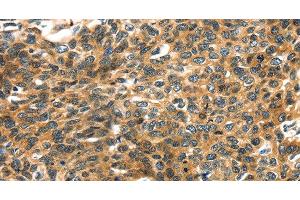 Immunohistochemistry of paraffin-embedded Human esophagus cancer using PRSS50 Polyclonal Antibody at dilution of 1:30 (PRSS50 Antikörper)