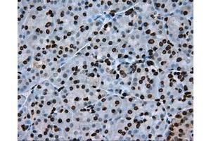 Immunohistochemical staining of paraffin-embedded Adenocarcinoma of colon tissue using anti-ARNTL mouse monoclonal antibody. (ARNTL Antikörper)