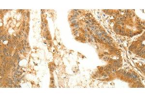 Immunohistochemistry of paraffin-embedded Human colon cancer tissue using RARRES1 Polyclonal Antibody at dilution 1:60 (RARRES1 Antikörper)