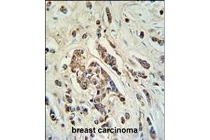 ABCC11 Antibody (N-term) (ABIN650984 and ABIN2840023) IHC analysis in formalin fixed and paraffin embedded breast carcinoma followed by peroxidase conjugation of the secondary antibody and DAB staining.