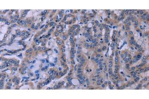 Immunohistochemistry of paraffin-embedded Human thyroid cancer tissue using TUBGCP2 Polyclonal Antibody at dilution 1:50 (TUBGCP2 Antikörper)