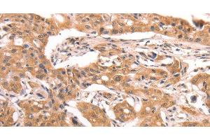 Immunohistochemistry of paraffin-embedded Human lung cancer using AASDHPPT Polyclonal Antibody at dilution of 1:30 (AASDHPPT Antikörper)