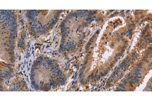 Immunohistochemistry of paraffin-embedded Human colon cancer tissue using FAAH2 Polyclonal Antibody at dilution 1:30 (FAAH2 Antikörper)