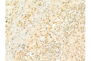 ABIN7094501 and ABIN7098550 at 1/100 staining Human liver cancer by IHC-P. (PRDM16 Antikörper  (Internal Region))