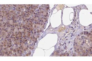 ABIN6273253 at 1/100 staining Human pancreas cancer tissue by IHC-P. (GSTM4 Antikörper  (Internal Region))