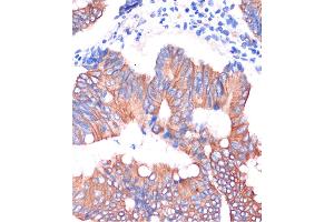 Immunohistochemistry of paraffin-embedded Human colon carcinoma using CGN Rabbit pAb (ABIN7266400) at dilution of 1:100 (40x lens). (Cingulin Antikörper  (AA 904-1203))